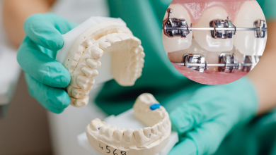 قالب‌ گیری ارتودنسی