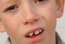 لب پر شدن دندان کودک
