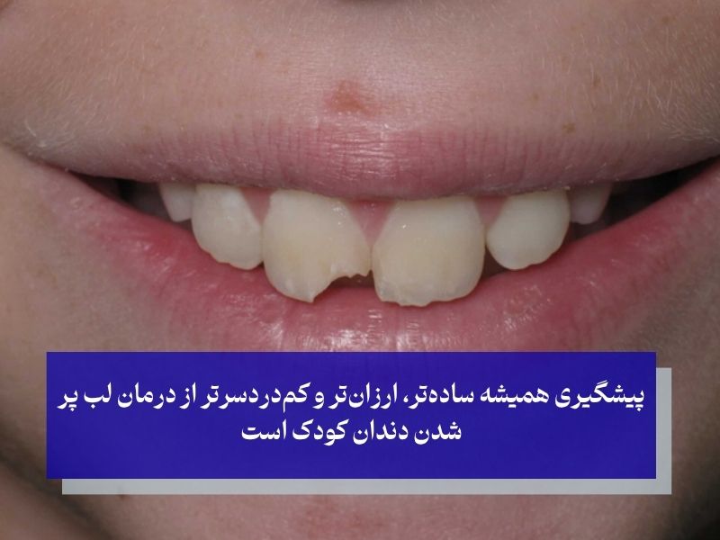 لب‌ پر شدن دندان کودک؛ آیا می‌توان از آن پیشگیری کرد
