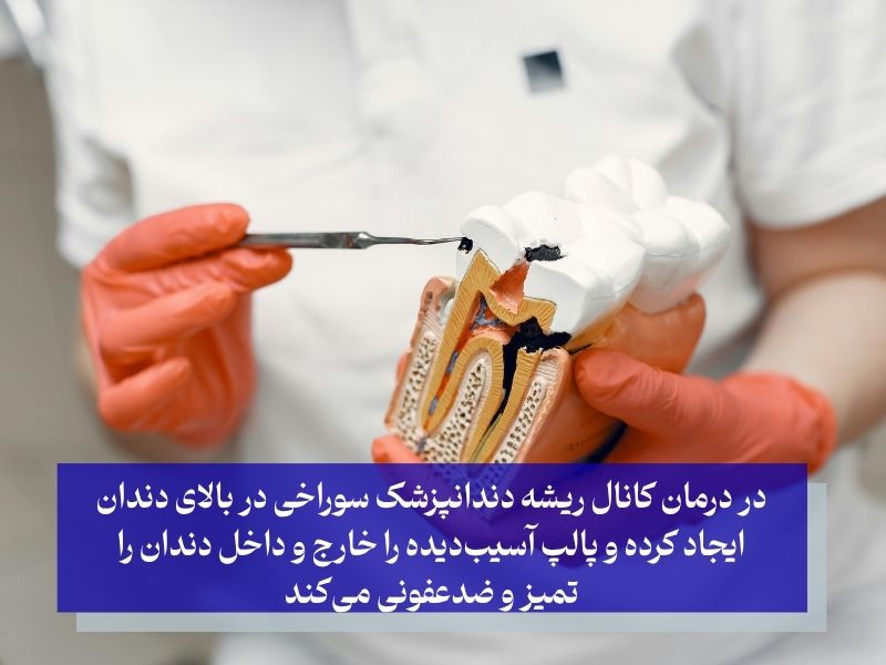 مراحل انجام عصب کشی دندان