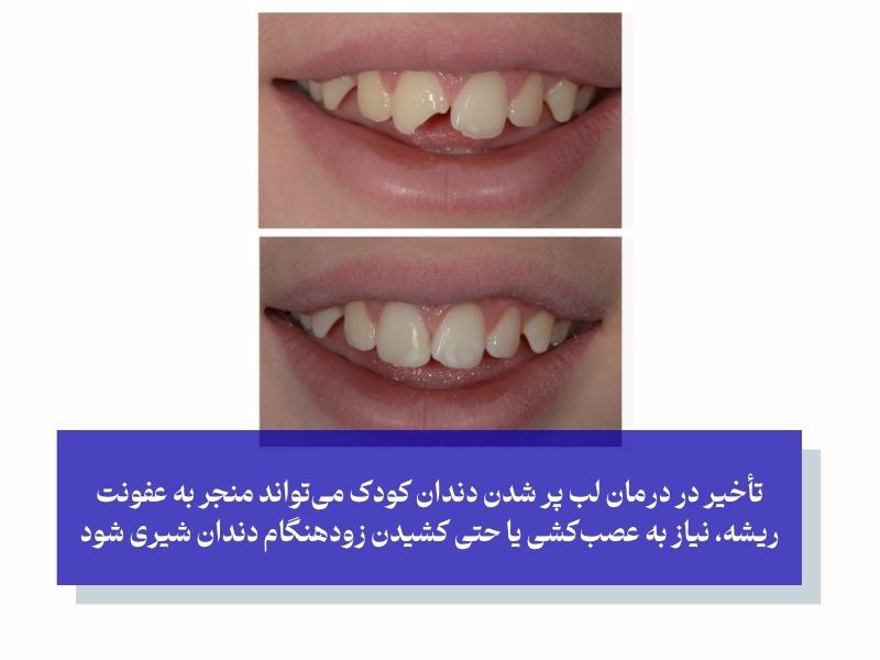 چه زمانی لب‌ پر شدن دندان کودک خطرناک است