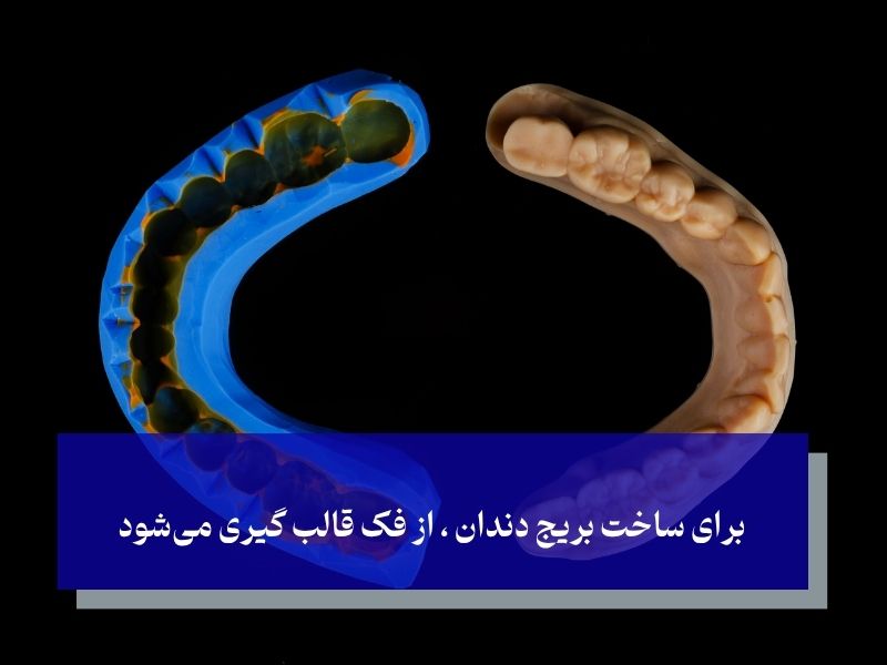 برای ساخت بریج دندان ، از فک قالب گیری میشود