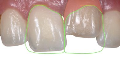 دندان فک جوش