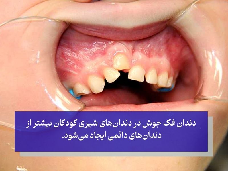 دندان فک جوش در دندان‌های شیری کودکان بیشتر از دندان‌های دائمی ایجاد می‌شود. 