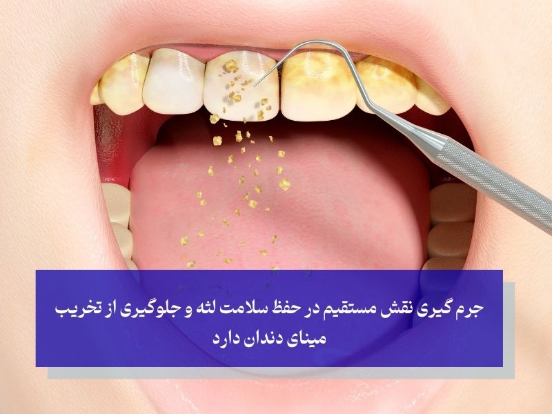 جرم‌ گیری نقش مستقیم در حفظ سلامت لثه و جلوگیری از تخریب مینای دندان دارد