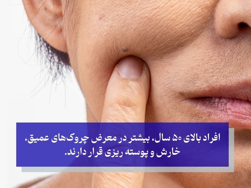 افراد بالای ۵۰ سال، بیشتر در معرض چروکهای عمیق، خارش و پوسته ریزی قرار دارند.
