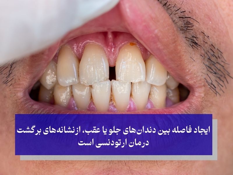 ایجاد فاصله بین دندانهای جلو یا عقب، ازنشانههای احتمال برگشت درمان ارتودنسی است