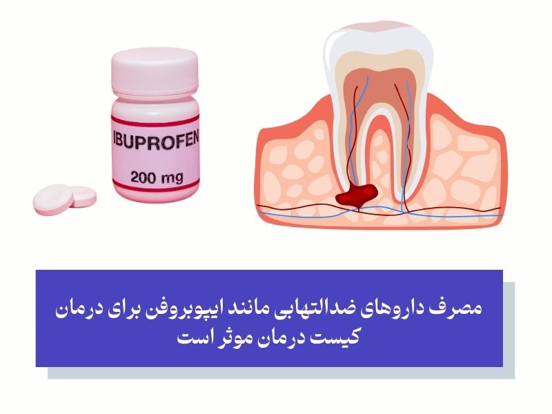 مصرف داروهای ضدالتهابی مانند ایپوبروفن برای درمان کیست درمان موثر است