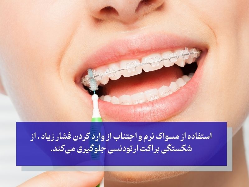 استفاده از مسواک نرم و اجتناب از وارد کردن فشار زیاد ، از شکستگی براکت ارتودنسی جلوگیری می‌کند.