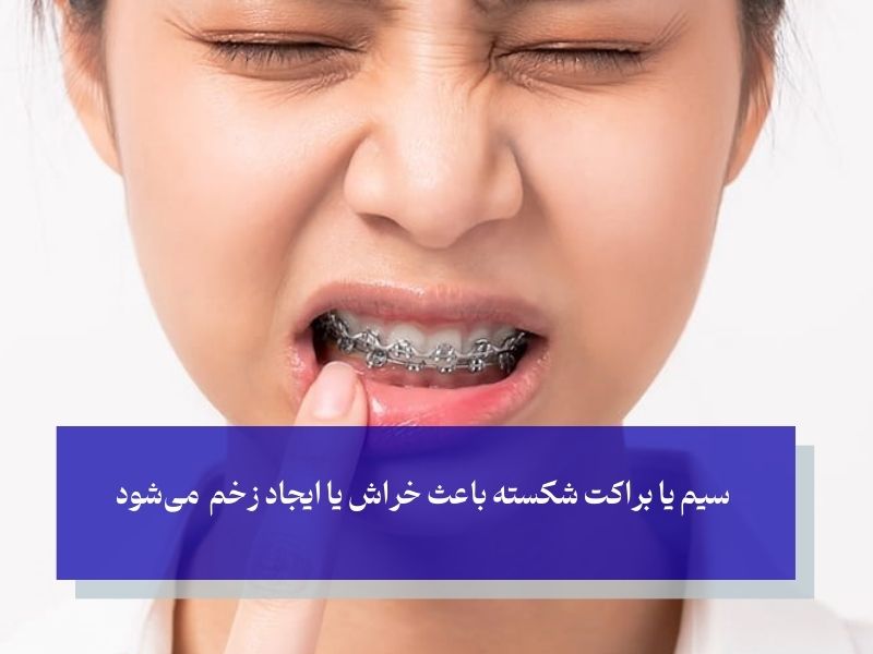 فرو رفتن سیم ارتودنسی به لثه