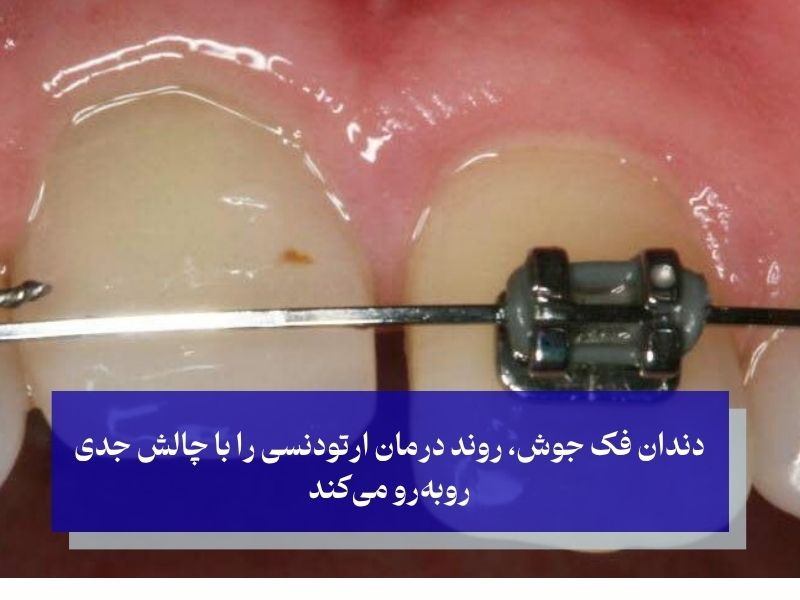 دندان فک جوش، روند درمان ارتودنسی را با چالش جدی روبه‌رو می‌کند