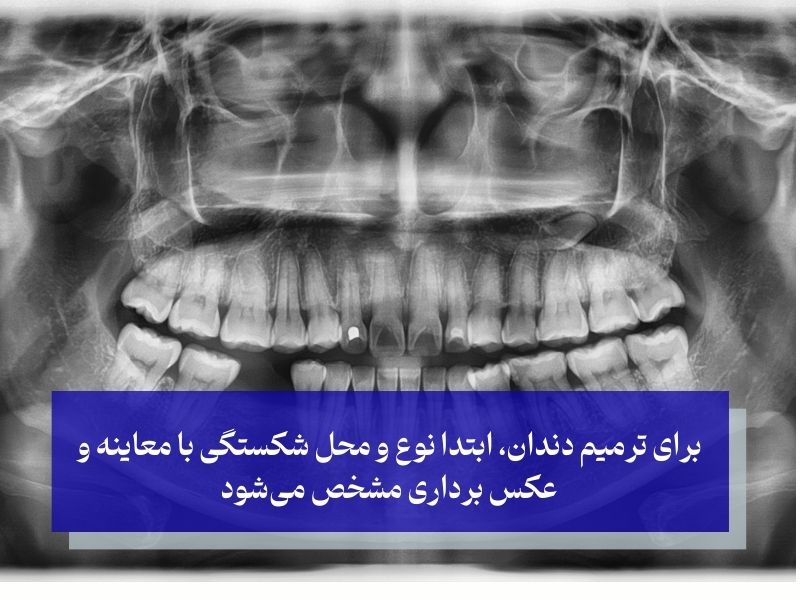 برای ترمیم دندان، ابتدا نوع و محل شکستگی با معاینه و عکس برداری مشخص میشود