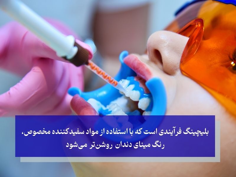 بلیچینگ فرآیندی است که با استفاده از مواد سفیدکننده مخصوص، رنگ مینای دندان روشن‌تر می‌شود