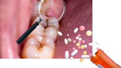 بهترین دارو برای کیست دندان