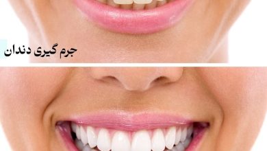 تفاوت جرم گیری و بلیچینگ دندان