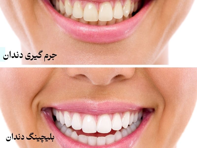 تفاوت جرم گیری و بلیچینگ دندان