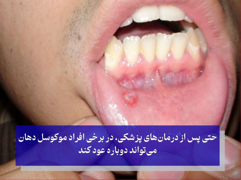 آیا موکوسل دهان عود می‌کند