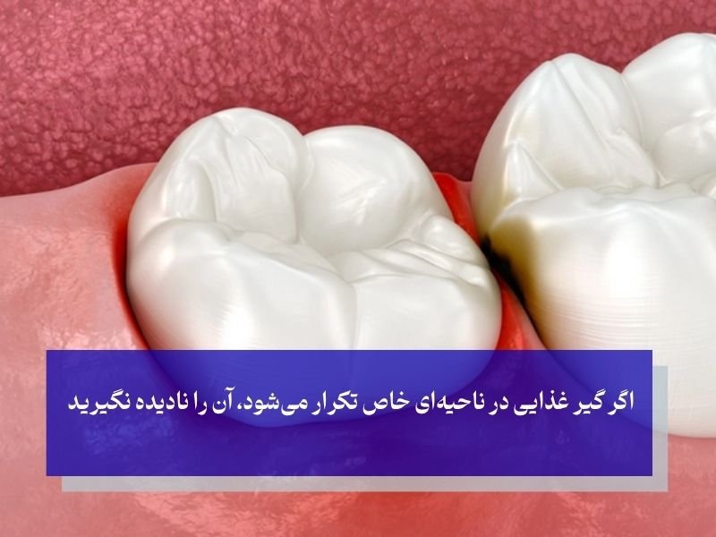 آیا گیر غذایی دندان می‌تواند باعث از دست رفتن دندان شود