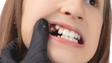 اصلاح دندان نیش بدون ارتودنسی