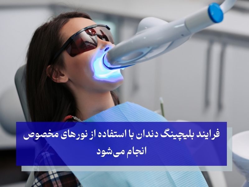بلیچینگ دندان