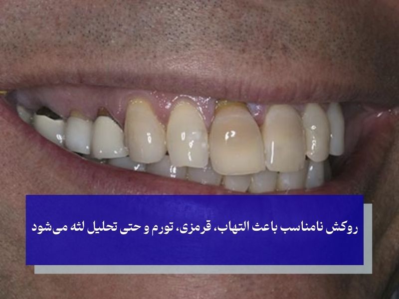 تحلیل لثه به دلیل کوتاه و بلند بودن روکش دندان