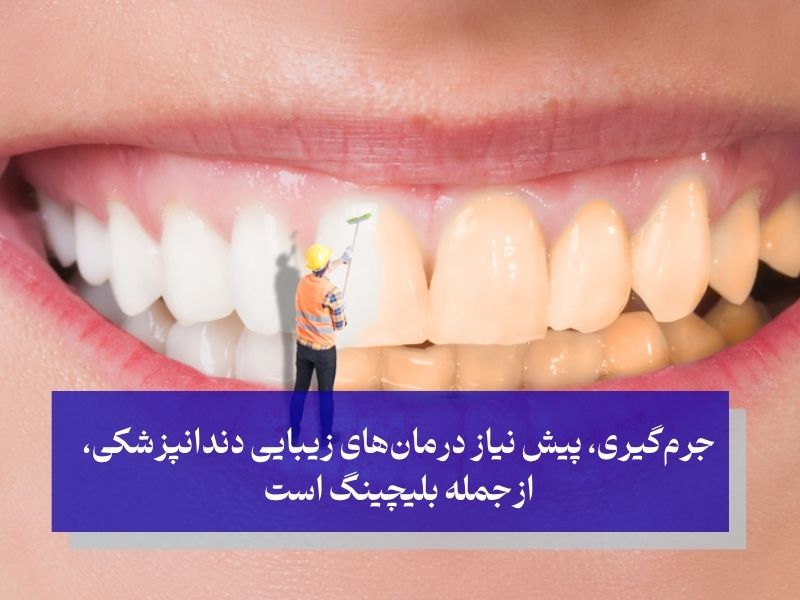 تفاوت بلیچینگ و جرم گیری