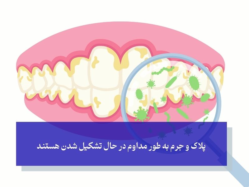 جرم‌گیری، یک بار در سال یا هر ۶ ماه