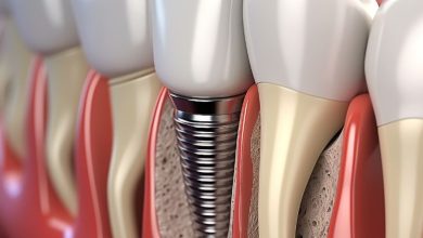 جوش خوردن ایمپلنت