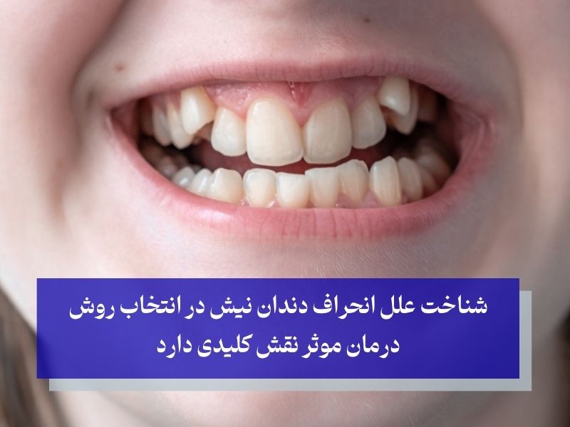 دلایل انحراف دندان نیش