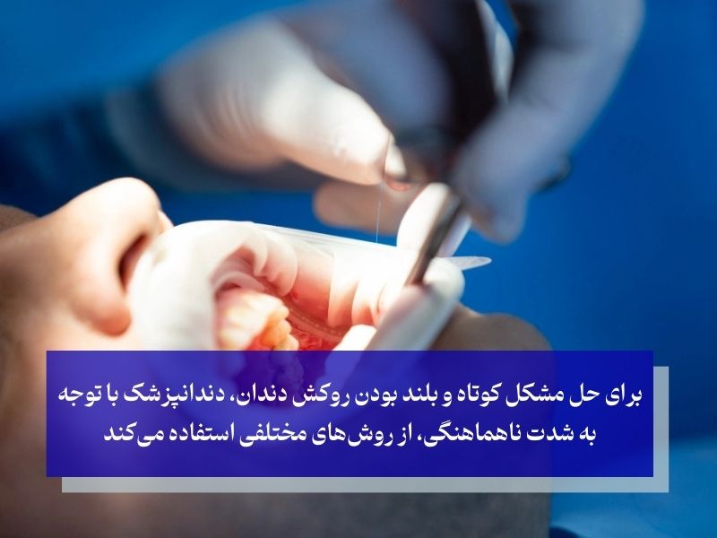 روش‌های اصلاح کوتاه و بلند بودن روکش دندان