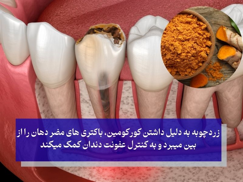 زردچوبه برای عفونت دندان