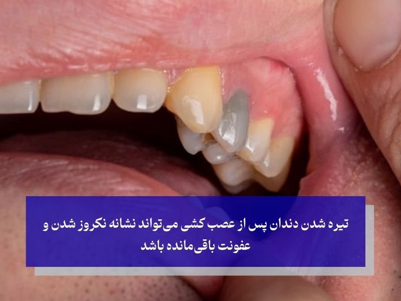 علائم عصب کشی ناموفق دندان؛ به این زنگ‌های خطر گوش دهید