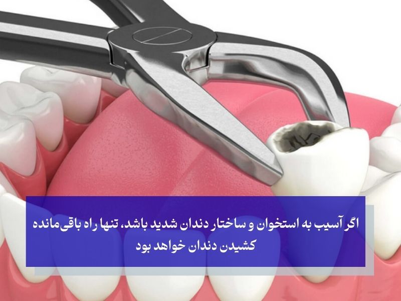 عوارض عصب کشی نادرست دندان؛ فراتر از یک دندان درد ساده