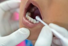 فلوراید تراپی کودکان