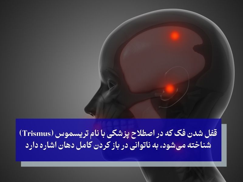 قفل شدن فک چیست