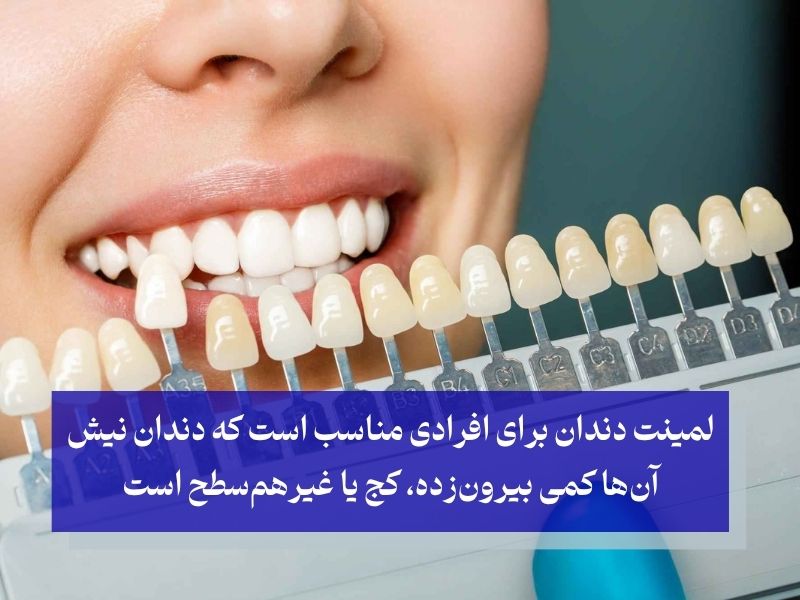 لمینت دندانی