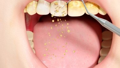 مراقبت های بعد از جرم گیری دندان