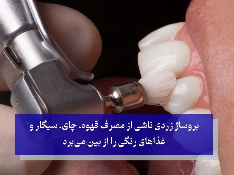 مزایای بروساژ دندان