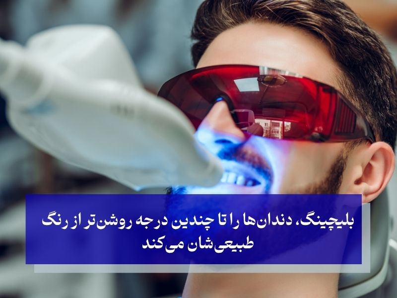 مزایای بلیچینگ دندان