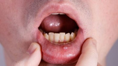 موکوسل دهان