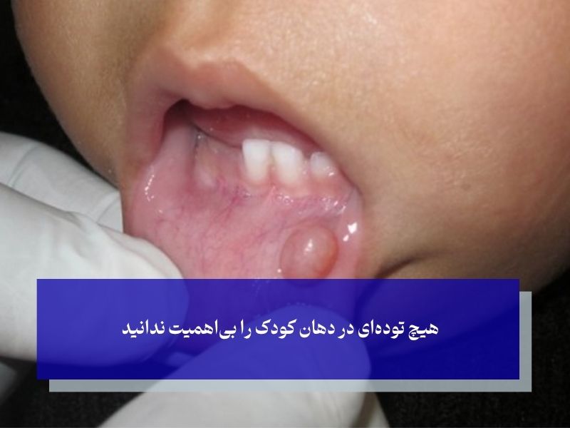 موکوسل دهان در کودکان