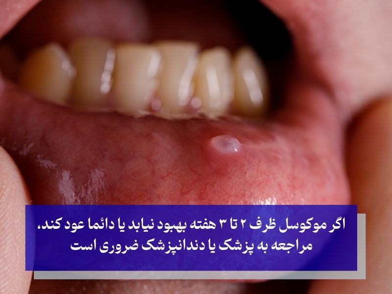 موکوسل دهان چه شکلی است؟ نشانه‌هایی که نباید نادیده بگیرید