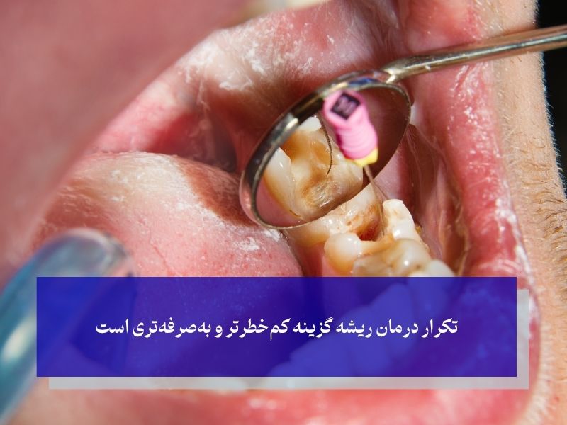 هزینه‌های ترمیم عصب‌کشی ناقص