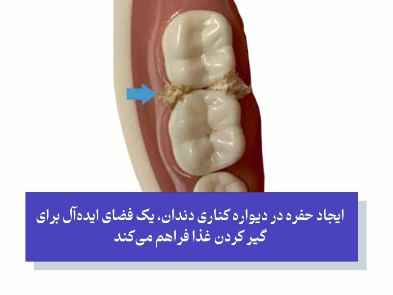 چرا مواد غذایی بین دندان‌های من گیر می‌کنند