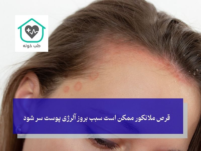 عوارض قرص ملانکور برای درمان سفیدی مو