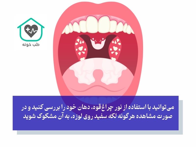 آیا می‌توان سنگ لوزه را در خانه تشخیص داد