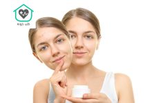 بهترین کرم ضد جوش و جای جوش