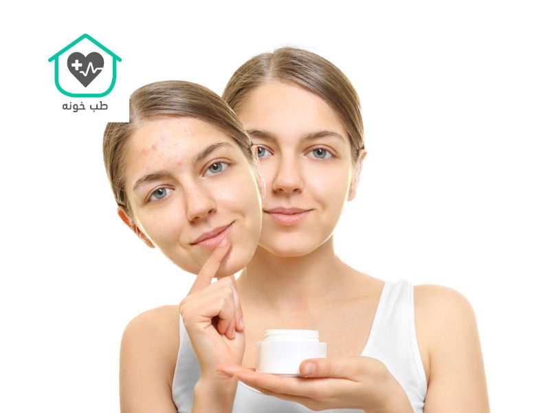 بهترین کرم ضد جوش و جای جوش