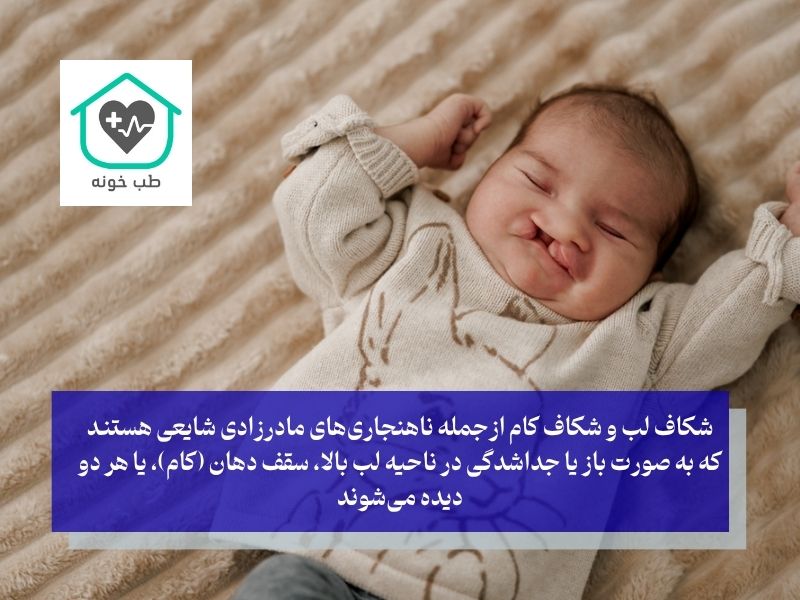 شکاف کام و لب