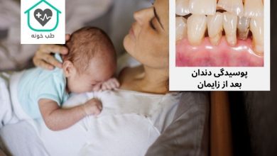 پوسیدگی دندان بعد از زایمان